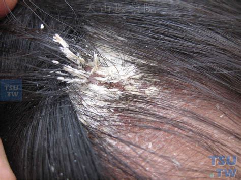 Maybe you would like to learn more about one of these? 石棉状糠疹（pityriasis amiantacea）症状表现 - 皮肤病诊断图谱 - 天山医学院