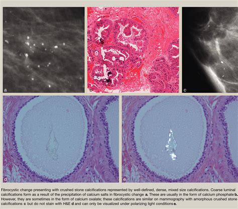 Benign Microcalcification And Its Differential Diagnosis In Breast Screening Diagnostic