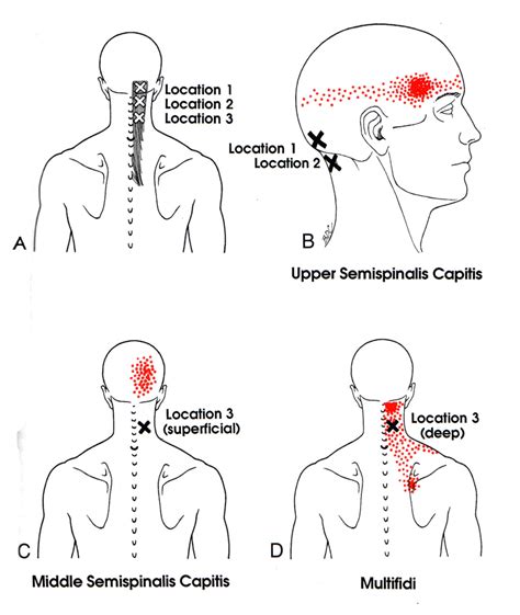 Semispinalis Capitis The Trigger Point And Referred Pain Guide