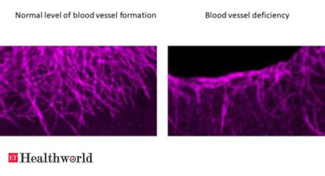 Mechanism For The Formation Of New Blood Vessels Discovered Health