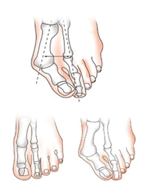 Taraklı ayak yapısına sahip olanların günlük aktivitelerini sıkıntı yaşamadan yapabilmek, ayaklarını ayakkabı içerisinde kolayca hareket ettirmek için ayakkabı tercihinde dikkat göstermesi gerekenler. Sıkça Sorulan Sorular - Ortocan Sağlık Hizmetleri