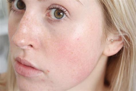 12 Easy And Effective Remedies To Get Rid Of Redness Of Face Naturally Redness On Face Best