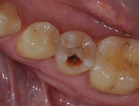 Decay On A Lower Second Bicuspid Lee Ann Brady Dmds Dental Blog