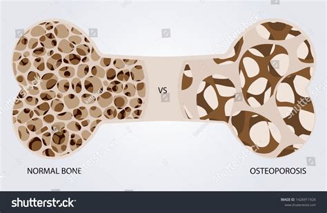 Vektor Stok Bone Osteoporosis Normal Bone Versus Osteoporosis Tanpa