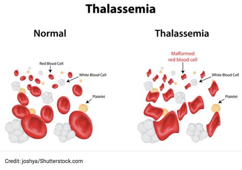 Beta Thalassemia Major Blood Smear