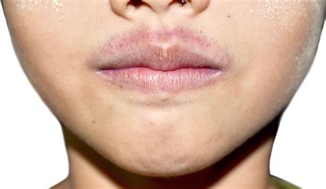 La hiperpigmentación del labio superior causas y remedios