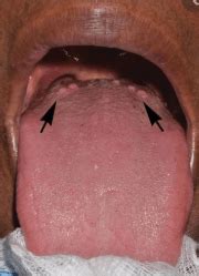 The Best Large Bumps On Back Of Tongue Near Throat Wallpapersseal Abc