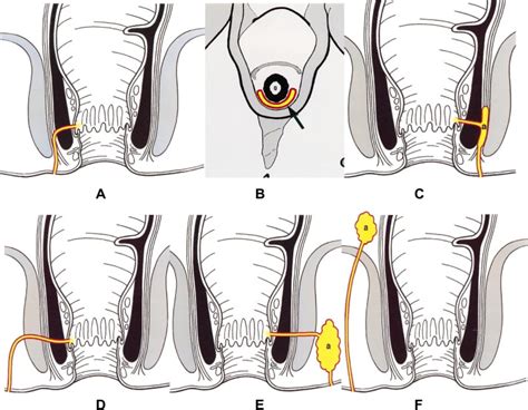 Anorectal Fistula Classification