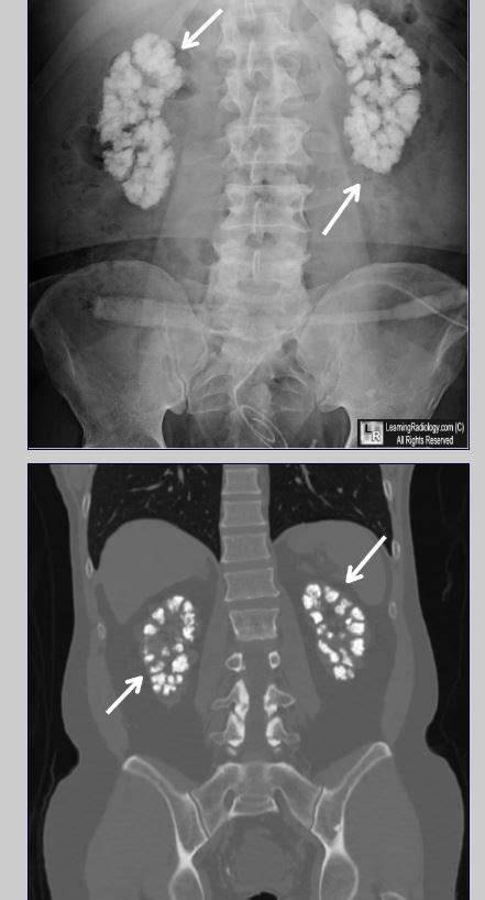 Medullary Nephrocalcinosis Upper Photo Of Conventional Radiograph Of