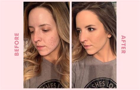 How To Cover Acne With Makeup—a Makeup Artists Story