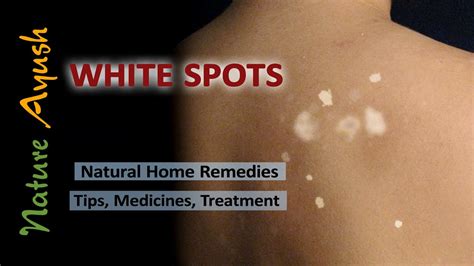 White Spots Top 6 Natural Health Remedies For White Spots By Dr