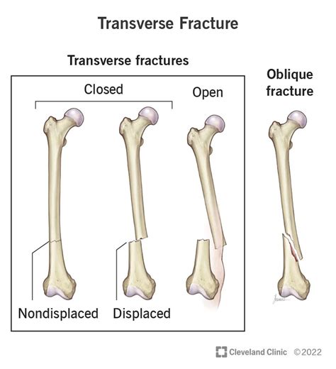 Transverse Fracture Symptoms Causes And Treatment