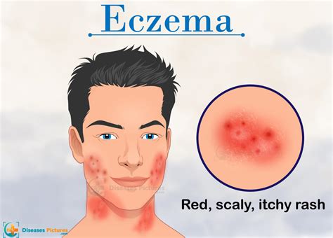 8 Home Remedies For Eczema Symptoms And Treatment Healthmd