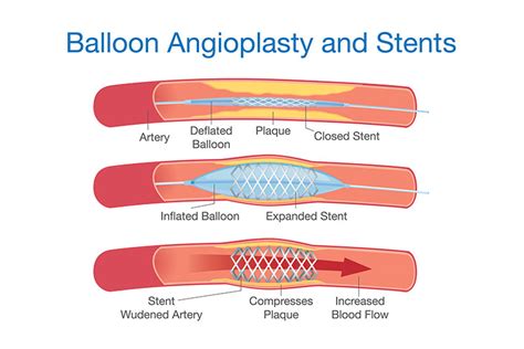 New York Balloon Angioplasty Peripheral Vascular Disease Treatment Nyc