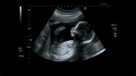 Baby Ultrasound What Should I Be Expecting During Visits