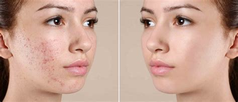 Difference Between Acne And Pimples Clearskin