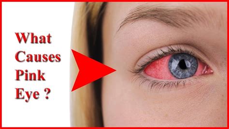 What Causes Pink Eye Top 5 Causes Of Pink Eye And Common