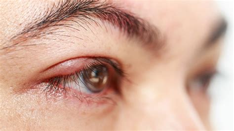 What Is A Stye Causes Treatment And Other Faqs Goodrx