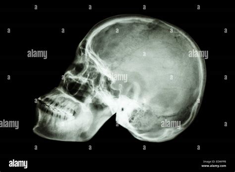 Normal Skull Xray Image Radiopaediaorg