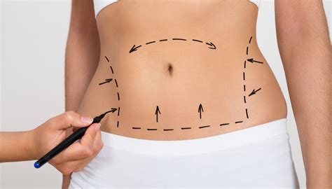 Tummy Tuck Belly Button Surgery Of The Belly To Obtain A Flat Stomach