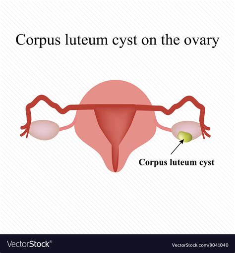 Corpus Luteum Cyst On Ovary Functional Cyst Vector Image