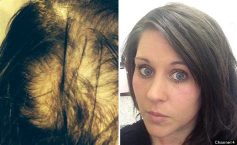 Woman Who Suffered Severe Hair Loss Undergoes