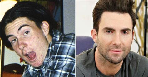 Famous People Describe Their Every Day Struggles With Acne