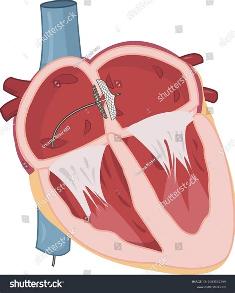 Pfo Closure Device Sealing Patent Foramen Stock Vector Royalty Free