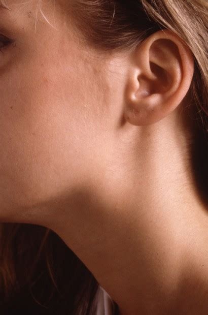 Though most throat cancers involve the same types of cells, specific terms are used to differentiate the part of the throat where cancer originated. NECK LUMPS | Dr John Chaplin Head and Neck Surgeon