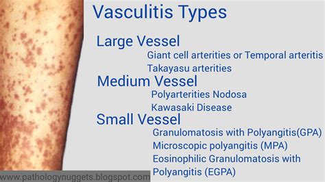 Approach To Types Of Vasculitis Easy Review Notes Of Large Medium