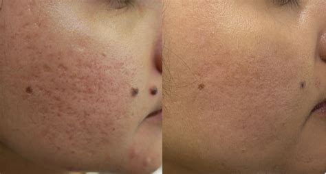 Co2 Laser Resurfacing For Acne Scars Cutis Dermatology