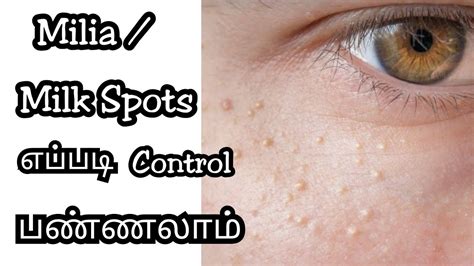 How To Get Rid Of Milia Milk Spots Home Remedies For Milia Tiny