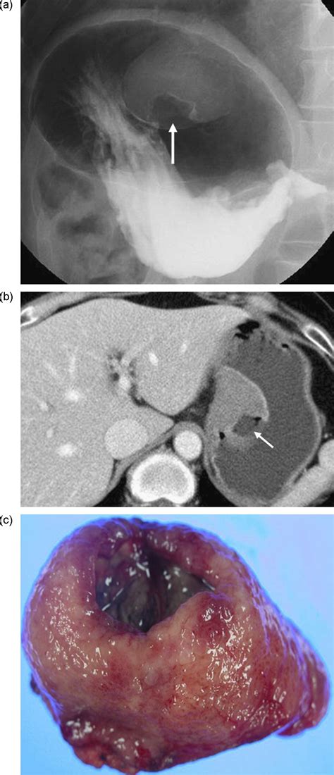 Benign Submucosal Lesions Of The Stomach And Duodenum Imaging