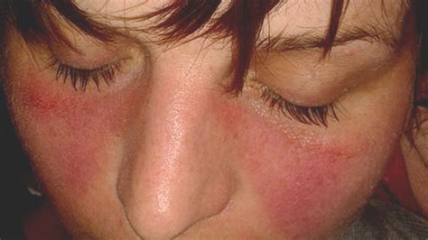 Find out about treatment and how you can ease your symptoms. A Closer Look at Lupus (Pictures)
