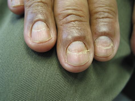 Details More Than 140 Nail Conditions And Diseases Best Ceg Edu Vn