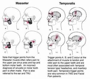 Trigger Points Referred Patterns In The Masseter Temporalis