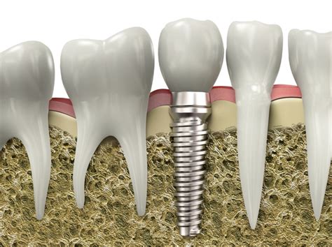 Dental Implants South Beach Dental