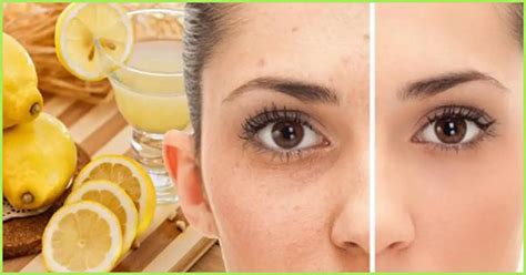 remove freckles and brown spots with this amazing diy all natural remedy