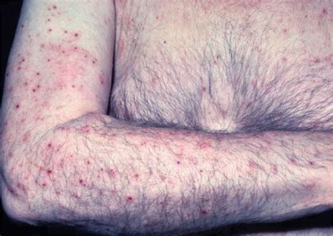 Bullous Pemphigoid Is Atypical In Elderly Caring For The Ages