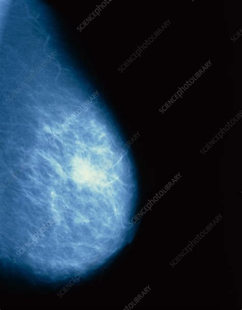 Mammogram Of A Female Breast Stock Image M1220016 Science Photo