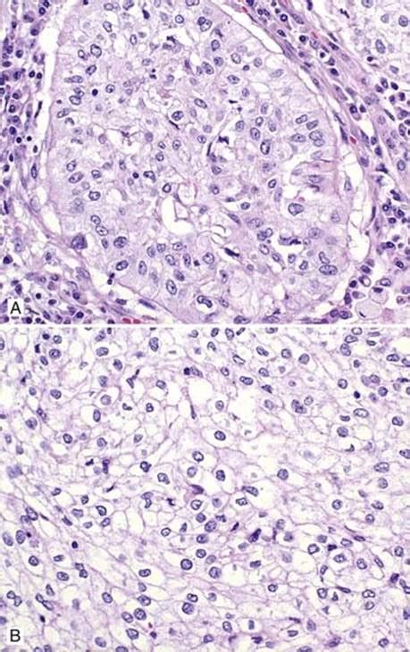 Clear Cell Variant Of Squamous Cell Carcinoma Scc Thoracic
