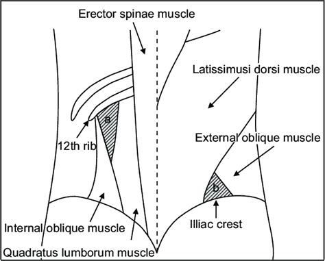 Anatomic Locations Of Lumbar Hernias A Superior Lumbar Hernia