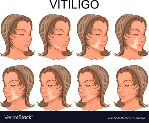 Vitiligo Treatment Before And After Royalty Free Vector