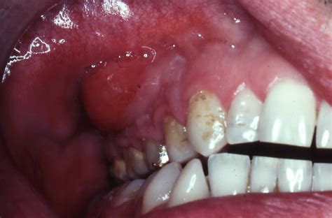 Gum Abscess All About Dental Abscesses Tooth Abscesses And Drainage Reverasite