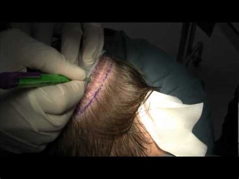 Joe Tillman Hair Transplant 4 Part 2 YouTube