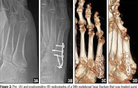 Figure 1 From Surgical Results Of Zones I And Ii Fifth Metatarsal Base Fractures Using Hook