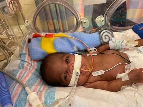 Alabama Babe Born Weeks Early Sets World Record For Most Premature