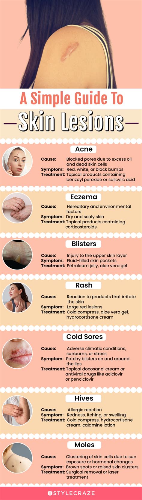 Skin Lesions Causes Symptoms And Treatments