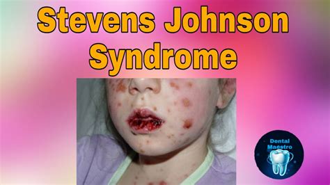 Stevens Johnson Syndrome Sjs Severe Skin Reaction Dental Maestro