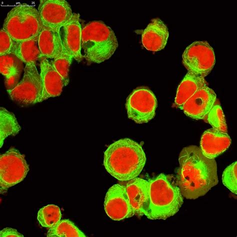 Real Fluorescence Microscopic View Of Human Neuroblastoma Cells — Stock